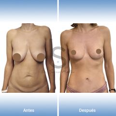 Mommy Makeover - Dr. José María Serra Mestre