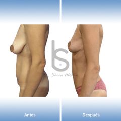 Mommy Makeover - Dr. José María Serra Mestre