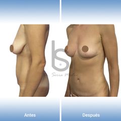 Mommy Makeover - Dr. José María Serra Mestre