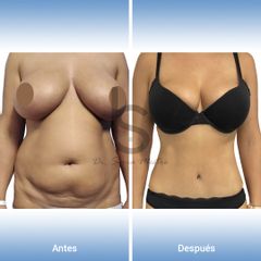 Abdominoplastia - Dr. José María Serra Mestre