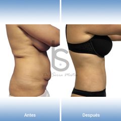 Abdominoplastia - Dr. José María Serra Mestre