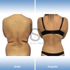 Abdominoplastia - Dr. José María Serra Mestre