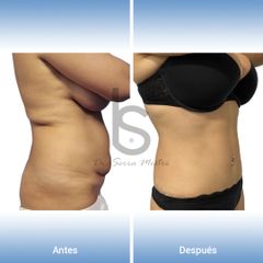 Abdominoplastia - Dr. José María Serra Mestre