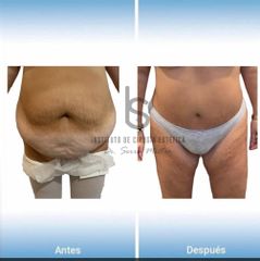 Abdominoplastia - Dr. José María Serra Mestre