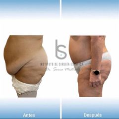 Abdominoplastia - Dr. José María Serra Mestre