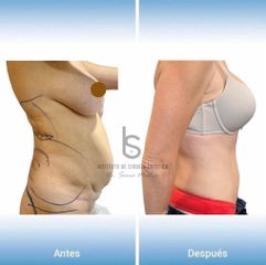 Abdominoplastia - Dr. José María Serra Mestre