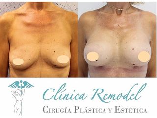 Aumento de pecho - Dra. Estefanía Poza Guedes