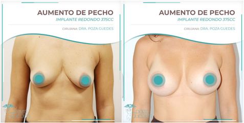 Aumento de pecho - Dra. Estefanía Poza Guedes