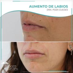 Aumento de labios - Dra. Estefanía Poza Guedes