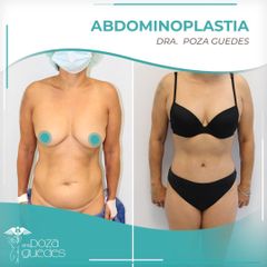 Abdominoplastia - Dra. Estefanía Poza Guedes