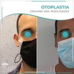 Otoplastia - Dra. Estefanía Poza Guedes