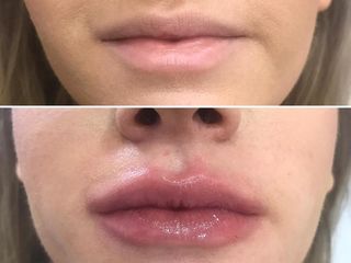Aumento hidratación de labios con ácido hialurónico