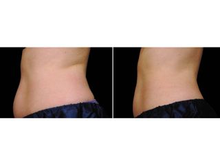 Antes y después Criolipólisis