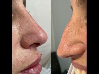 Rinoplastia - Dr. Diego Mayer y Dra. Sabrina Lambois