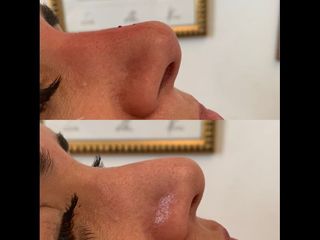 Rinoplastia - Dr. Diego Mayer y Dra. Sabrina Lambois