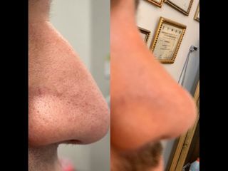 Rinoplastia - Dr. Diego Mayer y Dra. Sabrina Lambois