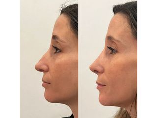 Rinoplastia - Dr. Ignacio Amado