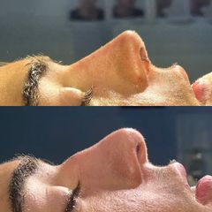 Rinoplastia - Dr. Ignacio Amado