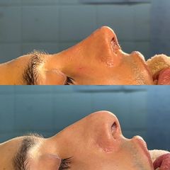 Rinoplastia - Dr. Ignacio Amado