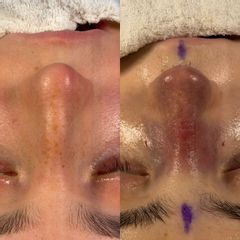 Rinoplastia - Dr. Ignacio Amado