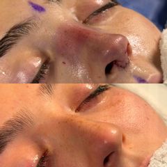 Rinoplastia - Dr. Ignacio Amado