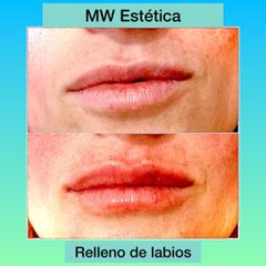 Relleno de labios - Mw Estética