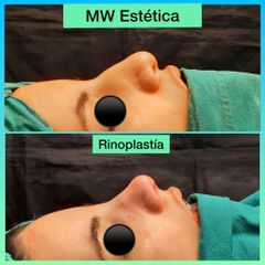 Rinoplastia - Mw Estética