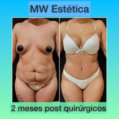 Abdominoplastia - Mw Estética
