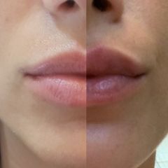 Relleno de labios con ácido hialurónico - antes y después .jpg
