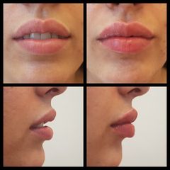 Relleno de labios con ácido hialurónico - antes y después
