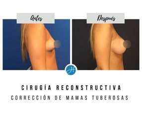 Mastopexia - Dr. Honorio Labaronnie