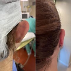 Otoplastia - Dr. Diego Cunille