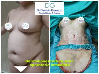 Abdominoplastia - Dr. Damián Galeazzo