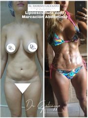 Lipoescultura de abdomen y marcación abdominal. Dr Galeazzo