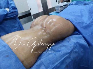 Gluteopastia Dr Damian Galeazzo
