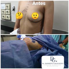 Aumento mamario. Antes y Despues. Dr Galeazzo