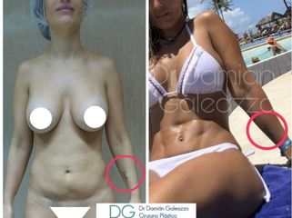 Lipoescultura. Marcación abdominal suave. Dr Galeazzo
