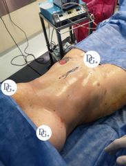 Lipoescultura. Marcación abdominal suave. Dr Galeazzo