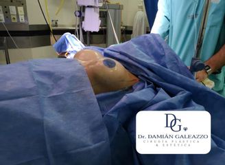 Aumento mamario. Dr Galeazzo