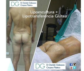 Lipotransferencia Glútea