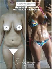 Lipoescultura - Dr. Damián Galeazzo