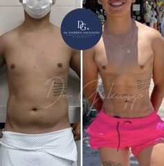 Liposucción - Dr. Damián Galeazzo