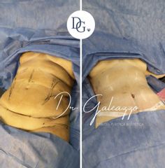 Abdominoplastia - Dr. Damián Galeazzo