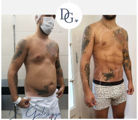 Nueva tecnología Renuvion - Dr. Damián Galeazzo