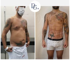 Lipoescultura - Dr. Damián Galeazzo
