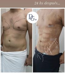 Lipoescultura - Dr. Damián Galeazzo