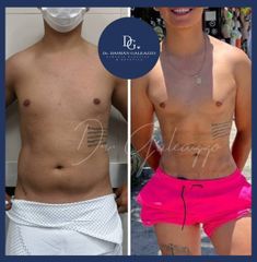Marcación abdominal - Dr. Damián Galeazzo