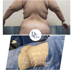 Lipoescultura - Dr. Damián Galeazzo