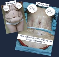 Dermolipectomía - Dr. Damián Galeazzo