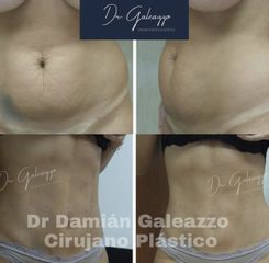 Liposucción - Dr. Damián Galeazzo
